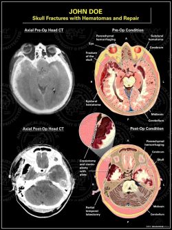 Skull Fractures with Hematomas and Repair