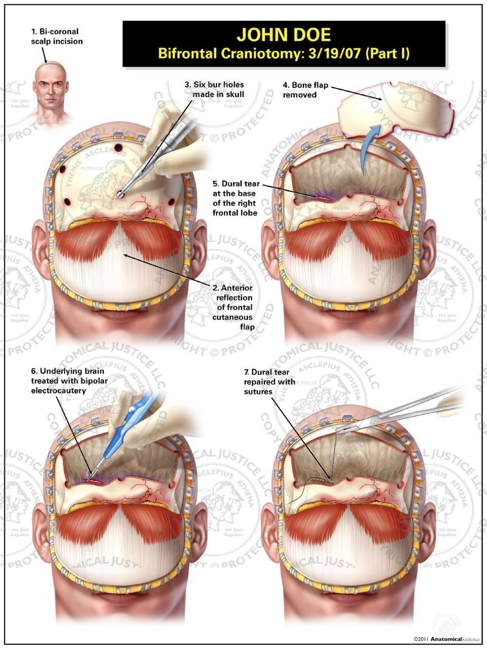 Bifrontal Craniotomy – Part I