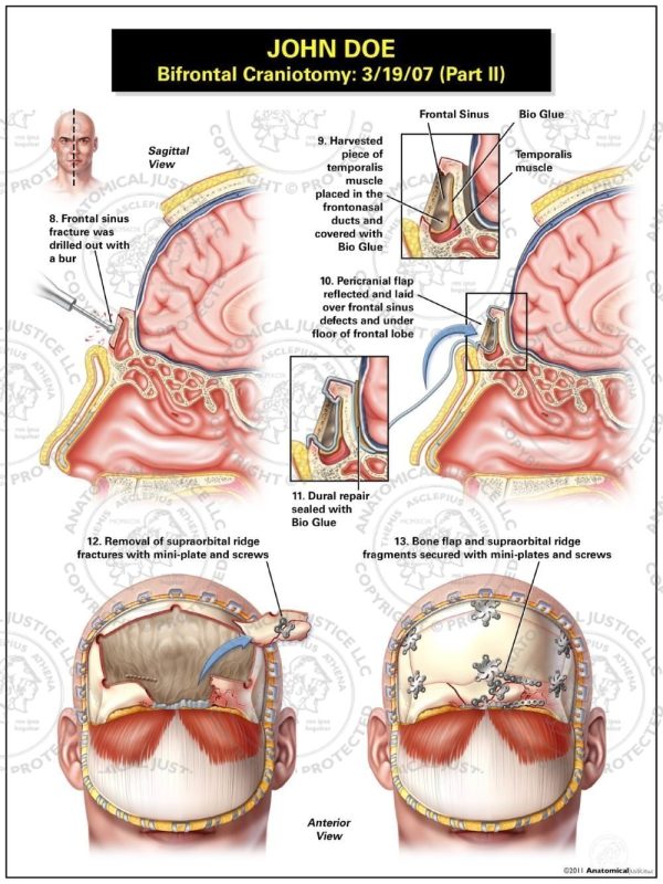 Bifrontal Craniotomy Part Ii 