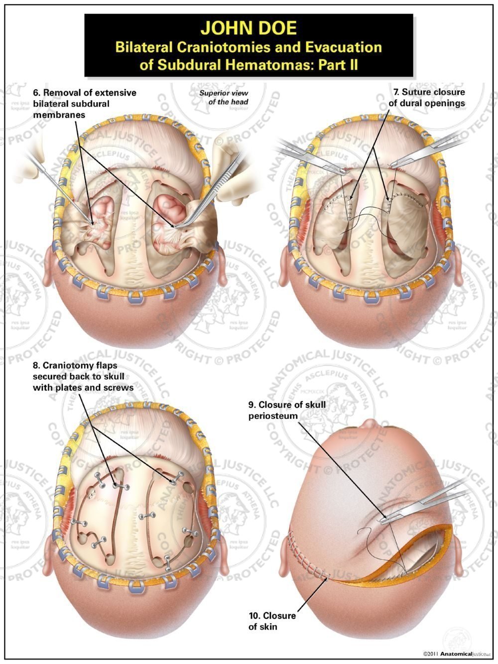 Bilateral Craniotomies and Evacuation of Subdural Hematomas: Part II