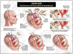 Craniotomy and Evacuation of Hematomas