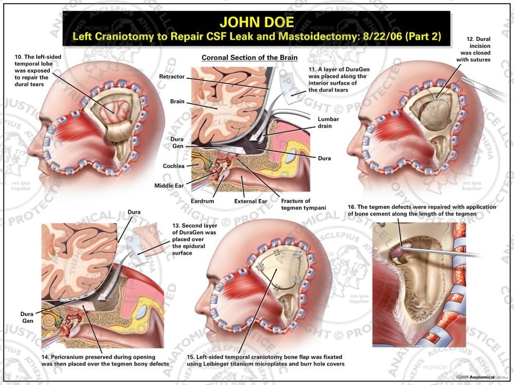 Left Craniotomy to Repair CSF Leak and Mastoidectomy – Part II