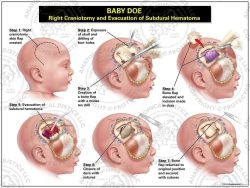 Right Craniotomy and Evacuation of Subdural Hematoma