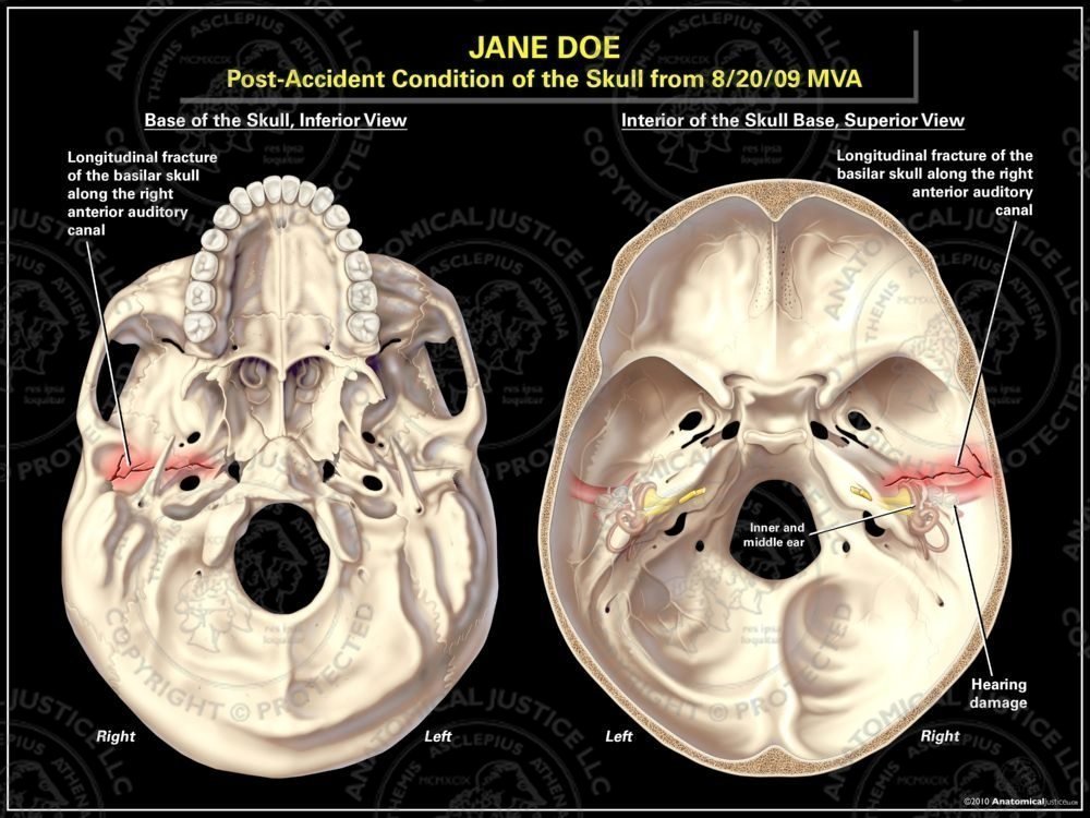 Basal Skull Fracture