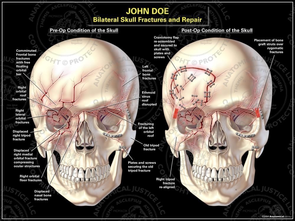 Orbital Frontonasal Tripod Skull Fractures and Repair