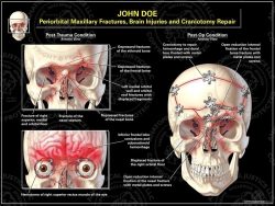 Periorbital Maxillary Fractures, Brain Injuries and Craniotomy Repair