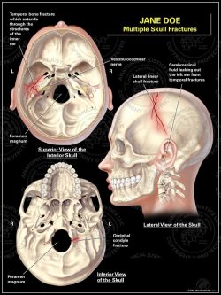 Superior Lateral and Inferior Skull Fractures