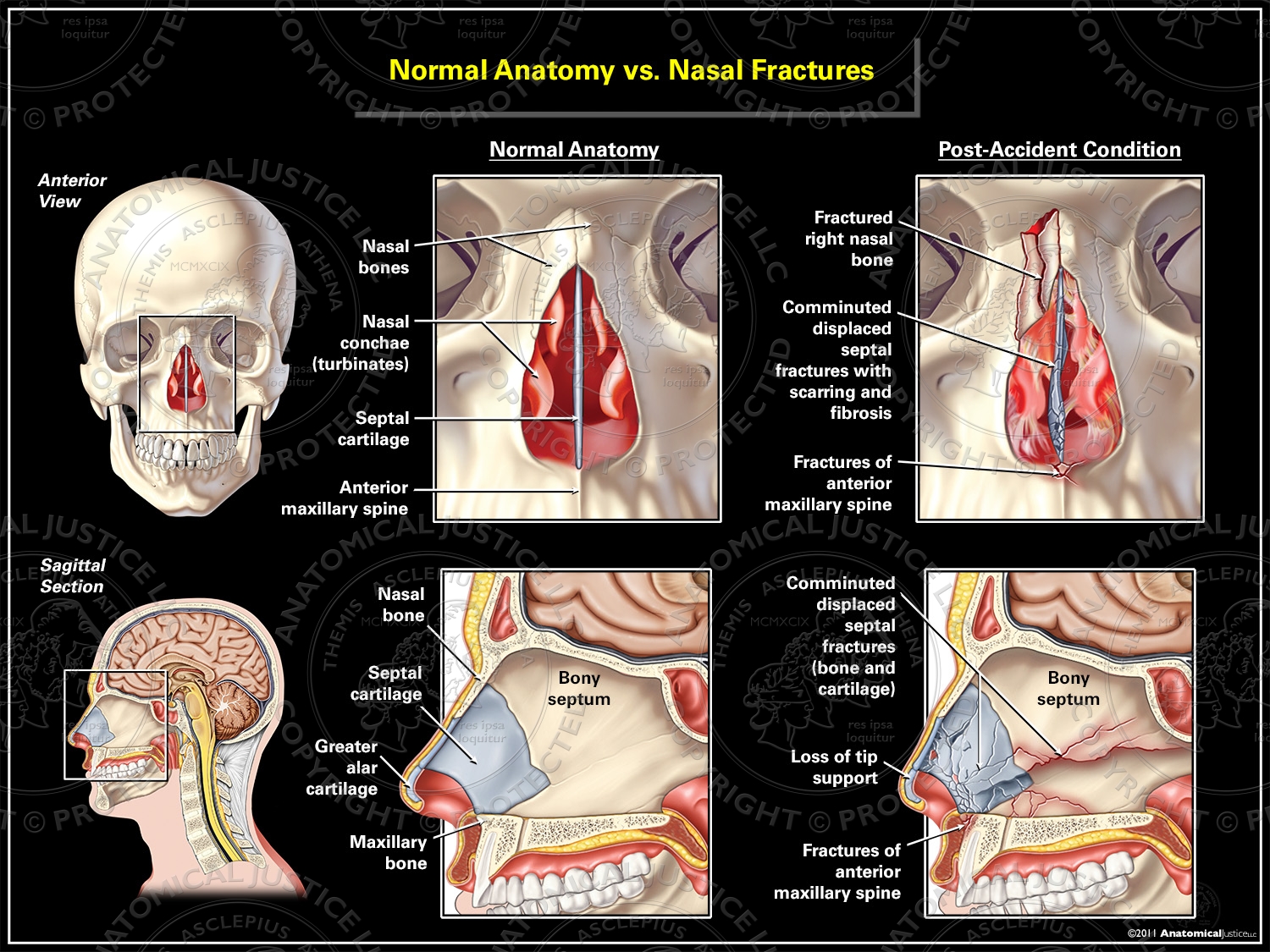 Normal Anatomy vs. Nasal Fractures