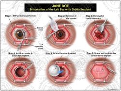 Evisceration of the Left Eye with Orbital Implant