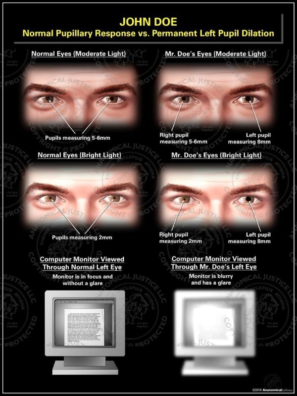 Normal Pupillary Response Vs Permanent Left Pupil Dilation