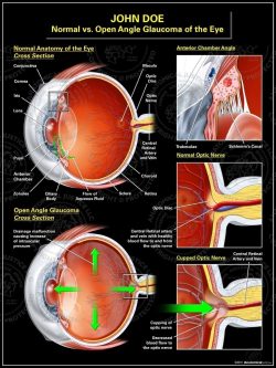 Normal vs. Open Angle Glaucoma of the Eye