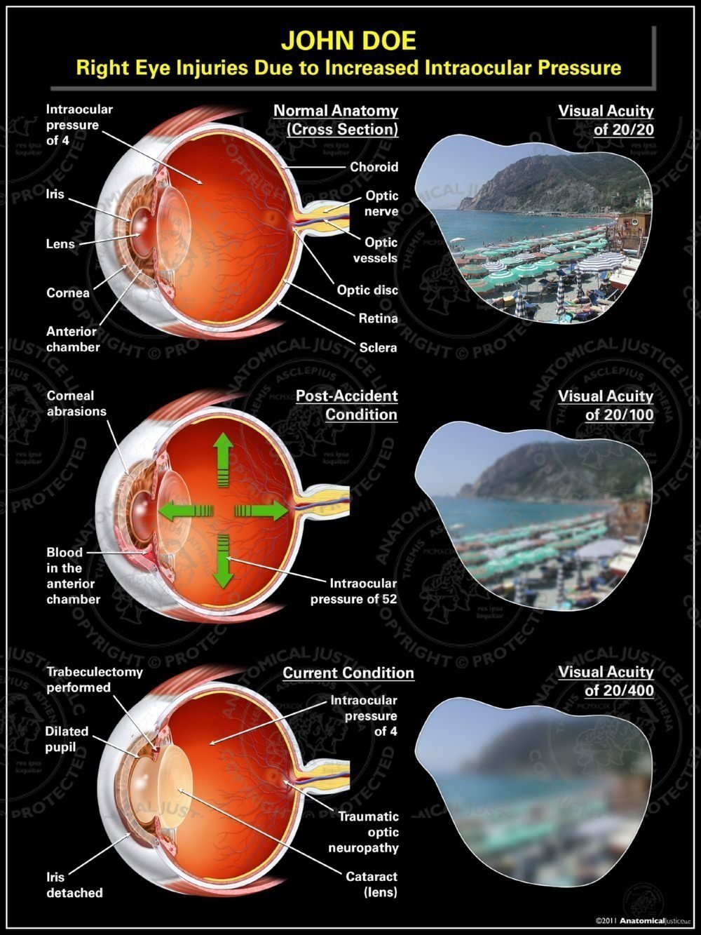 Right Eye Injuries Due to Increased Intraocular Pressure
