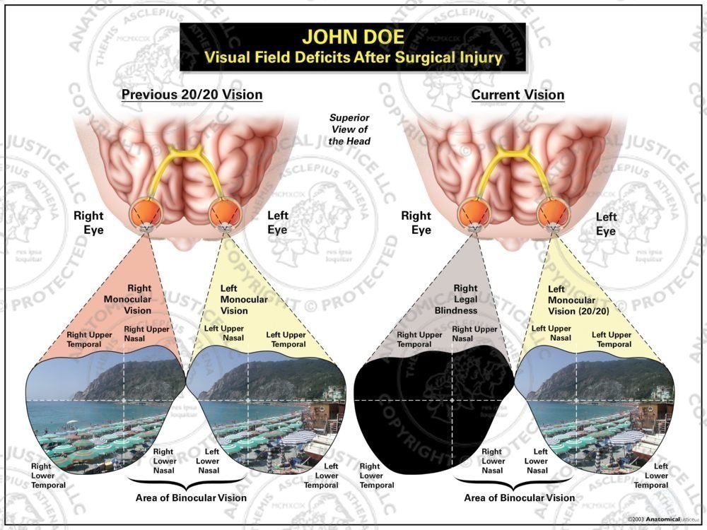 Visual Field Deficits After Surgical Injury