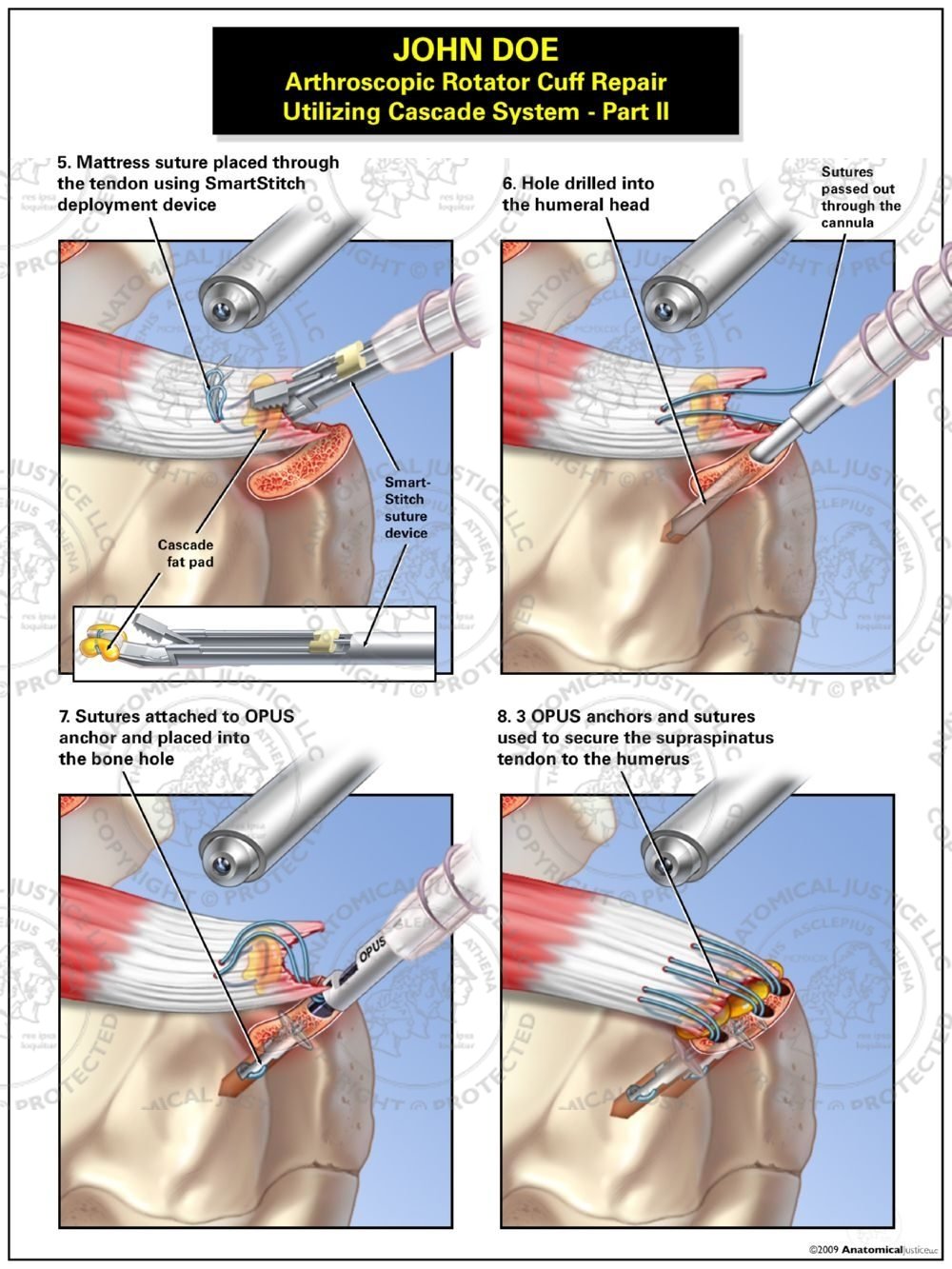 Arthroscopic Rotator Cuff Repair Utilizing Cascade System – Part II