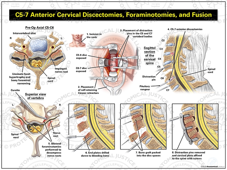 C5-7 Anterior Cervical Discectomies, Foraminotomies, and Fusion