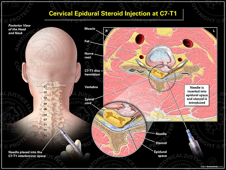 Cervical Epidural Steroid Injection at C7-T1
