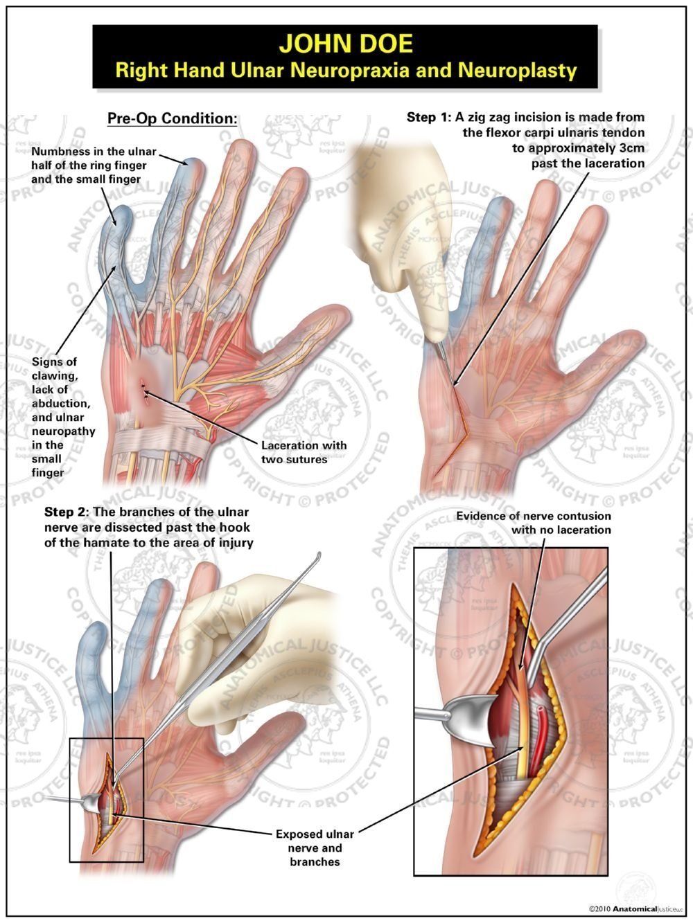 Right Hand Ulnar Neuropraxia and Neuroplasty