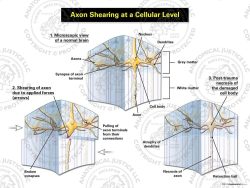 Axon Shearing at a Cellular Level – White