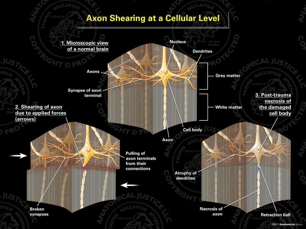 Axon Shearing at a Cellular Level – Black