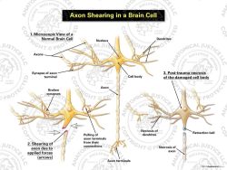 Axon Shearing in a Brain Cell – White