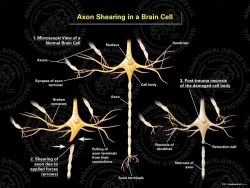 Axon Shearing in a Brain Cell – Black