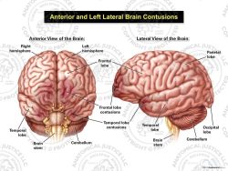 Anterior and Left Lateral Brain Contusions