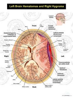 Left Brain Hematomas and Right Hygroma