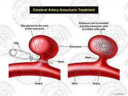 Cerebral Artery Aneurysm Treatment