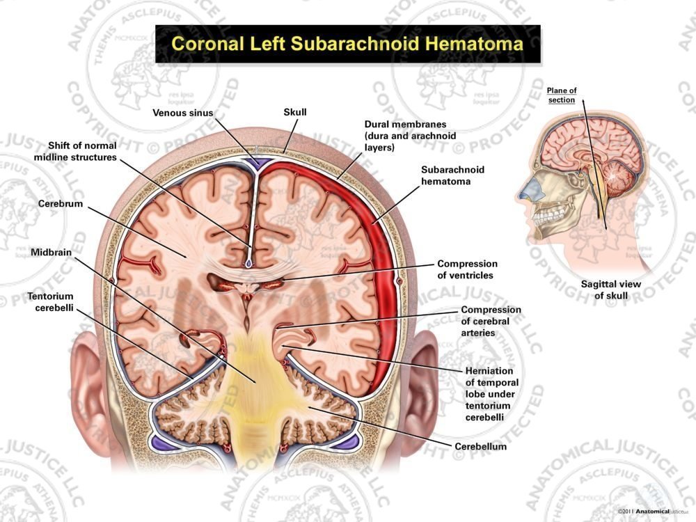 Coronal Left Subarachnoid Hematoma