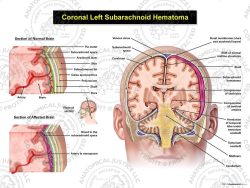 Coronal Left Subarachnoid Hematoma with Enlarged Details