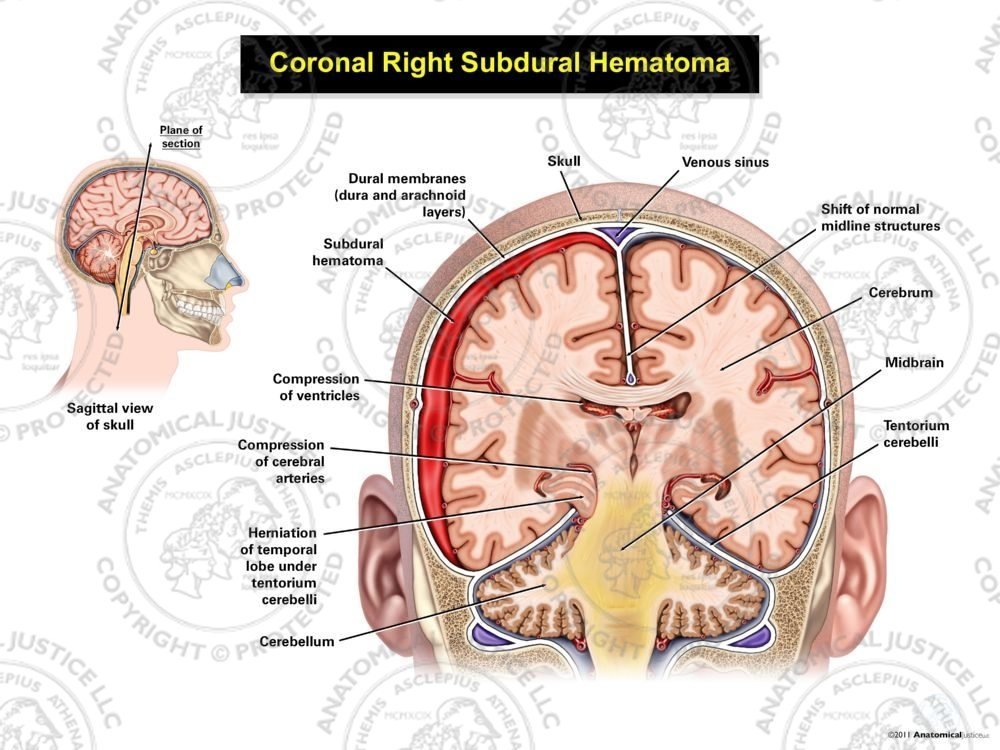 Coronal Right Subdural Hematoma
