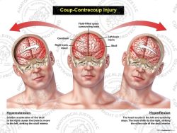 Male Anterior Coup – Contrecoup Injury