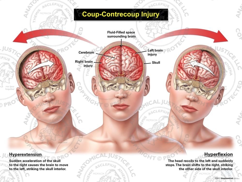 Female Anterior Coup – Contrecoup Injury