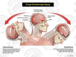 Male Lateral Coup – Contrecoup Injury