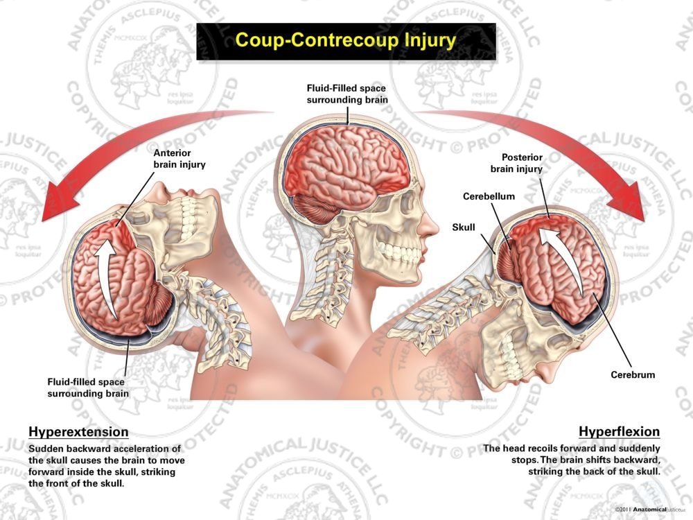 Female Lateral Coup – Contrecoup Injury