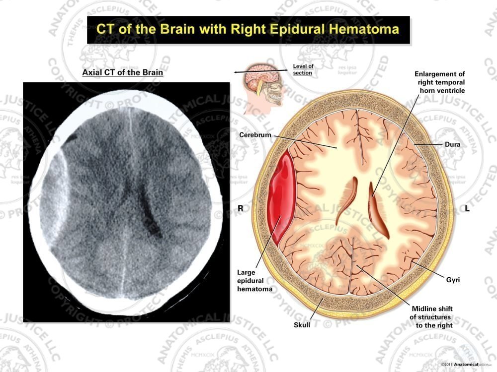 CT of the Brain with Right Epidural Hematoma