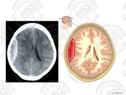 CT of the Brain with Right Epidural Hematoma – No Text