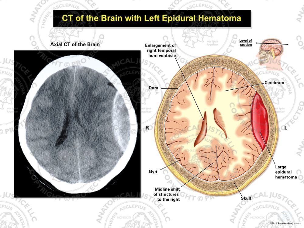 CT of the Brain with Left Epidural Hematoma