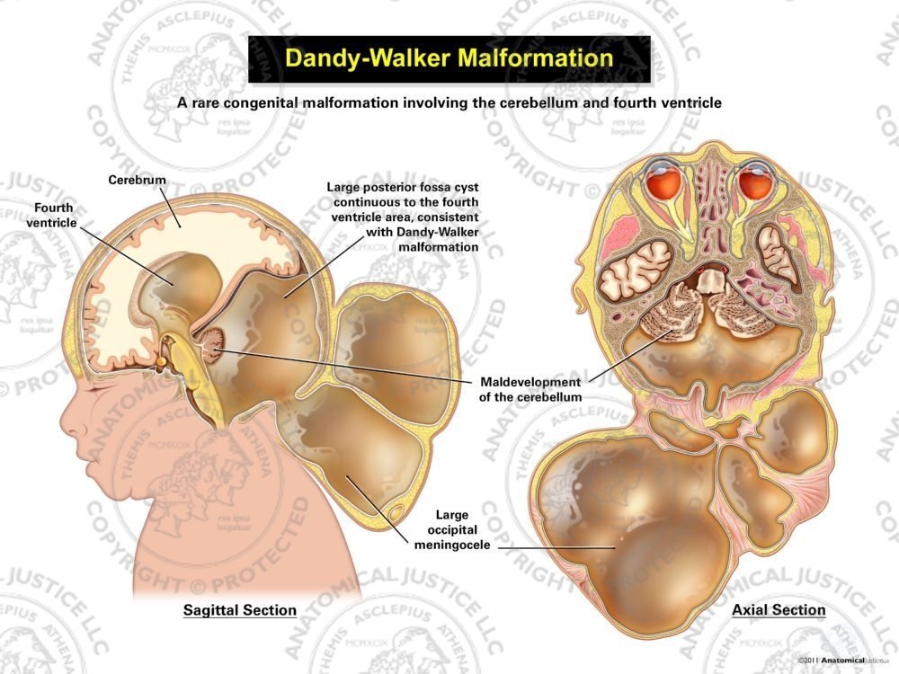 criticus compressie voorspelling Dandy Walker Malformation Illustration | Anatomical Justice