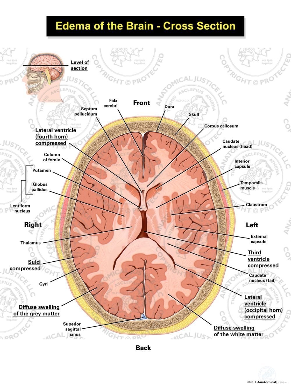 Edema of the Brain – Cross Section