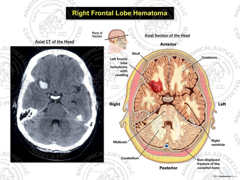 Right Frontal Lobe Hematoma