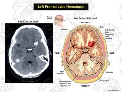 Left Frontal Lobe Hematoma