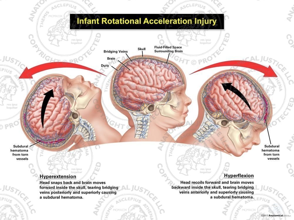 Infant Rotational Acceleration Injury