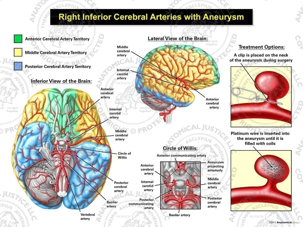 Right and Inferior Cerebral Arteries with Aneurysm