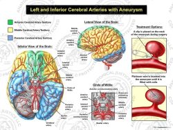 Left and Inferior Cerebral Arteries with Aneurysm