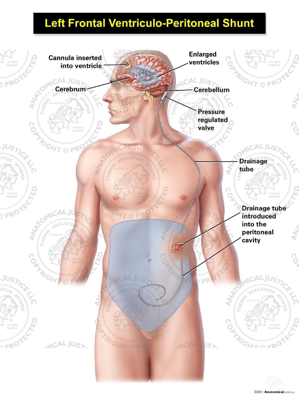 Male Left Frontal Ventriculo – Peritoneal Shunt