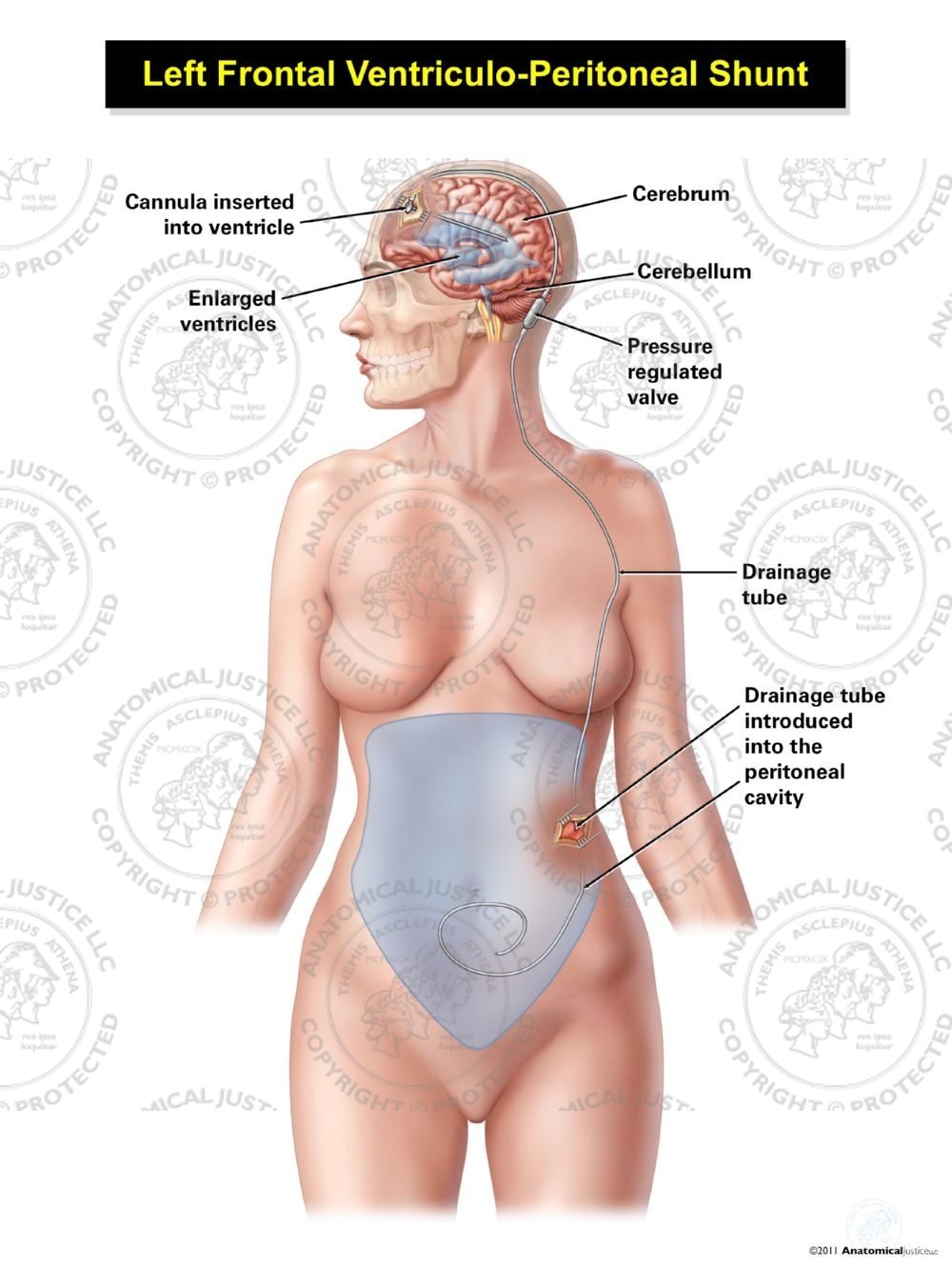Female Left Frontal Ventriculo – Peritoneal Shunt