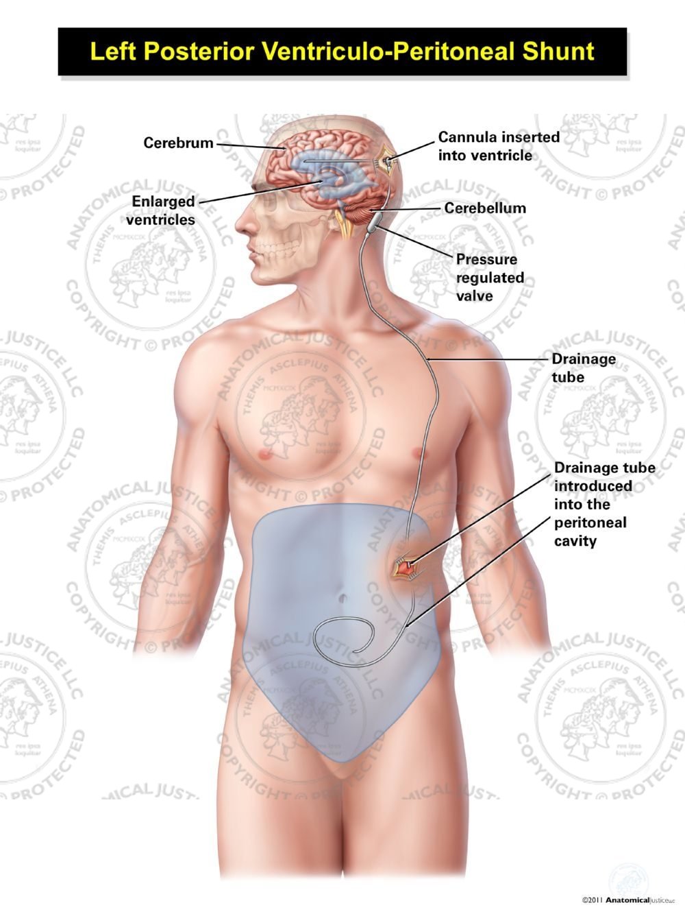 Male Left Posterior Ventriculo – Peritoneal Shunt
