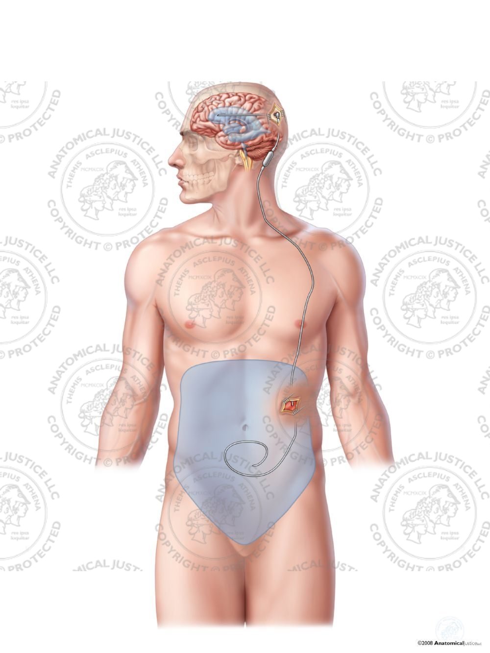 Male Left Posterior Ventriculo – Peritoneal Shunt – No Text