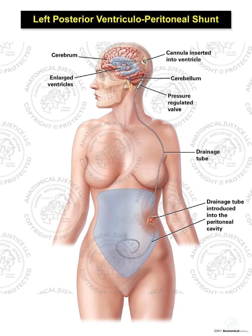 Female Left Posterior Ventriculo – Peritoneal Shunt